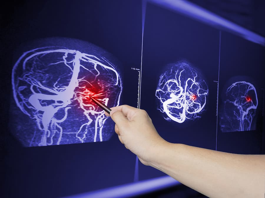 johnson city brain injury lawyer