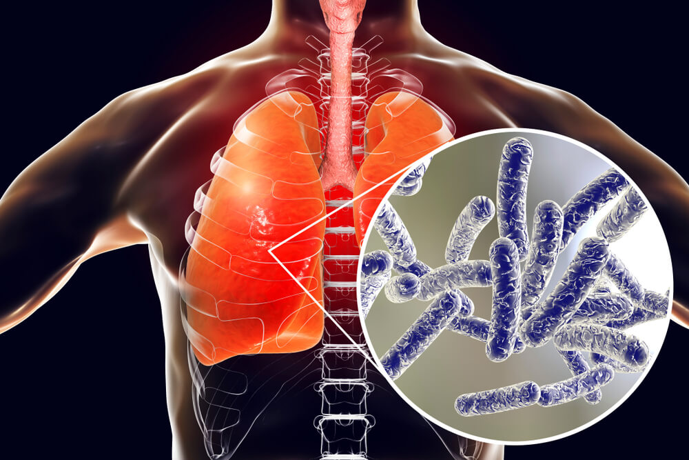 Legionella pneumophila bacteria in human lungs