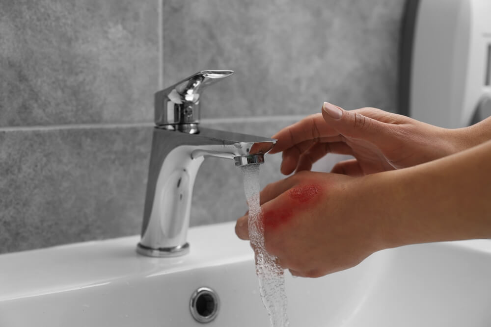 Woman holding burned hand under cold water indoors, closeup.