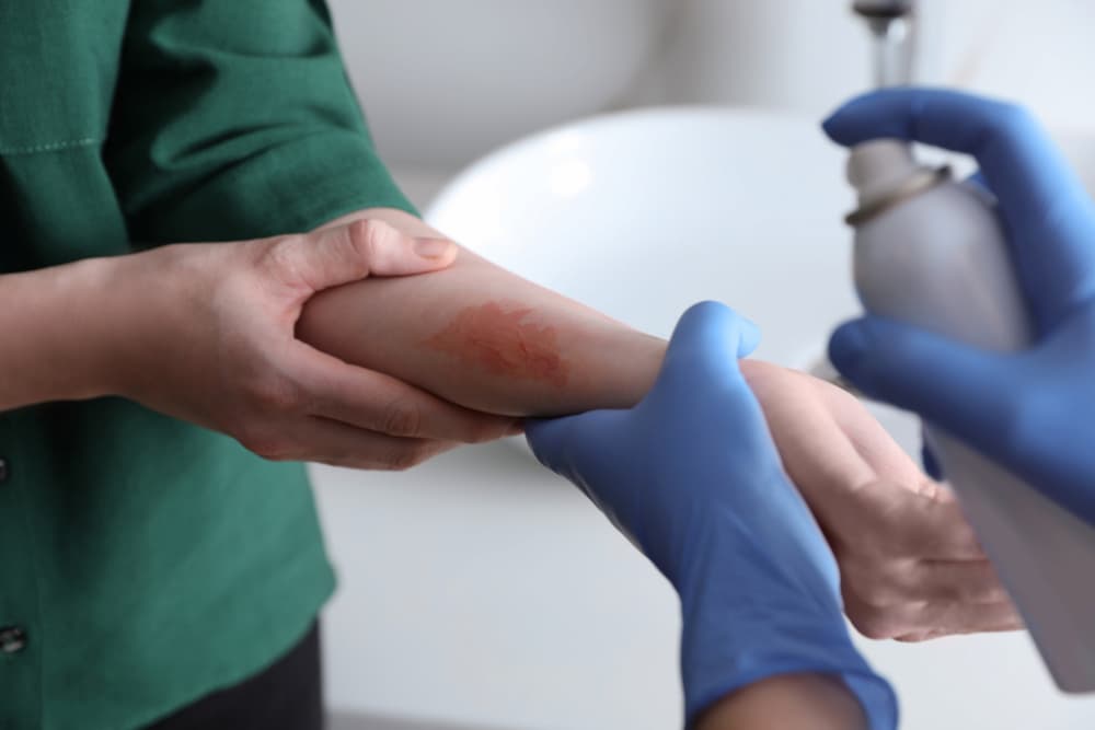 Applying Burn Spray onto Injured Skin, Closeup